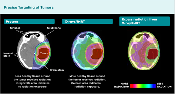 Proton beam therapy figure 2.png